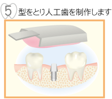 型をとり人口歯を制作します