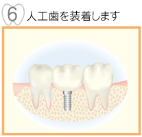 人口歯を装着します