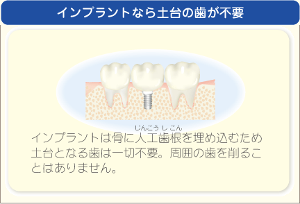 インプラントなら土台の歯が不要